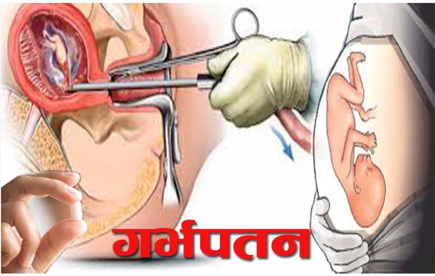 स्याङ्जा ३ वर्षमा २९१० जनाले  गरे सुरक्षित गर्भपतन